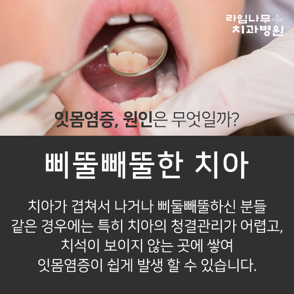 피곤하면 붓는 잇몸질환의 원인과 해결방법 관련 이미지 3