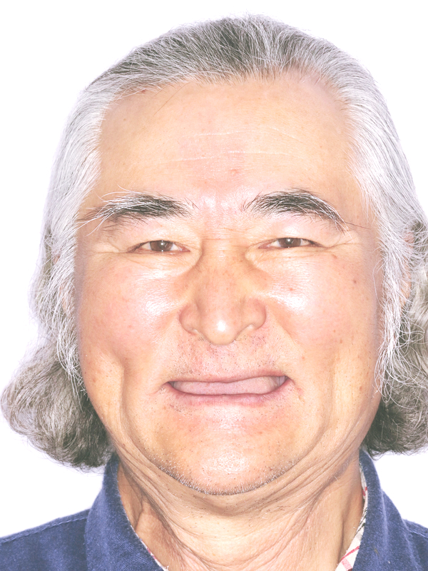 라임나무치과병원 내비게이션 전체 임플란트 식립사례 관련 이미지 1