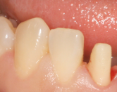 치아교정보다 빠른효과 나타내는 최소삭제 라미네이트! 관련 이미지 2