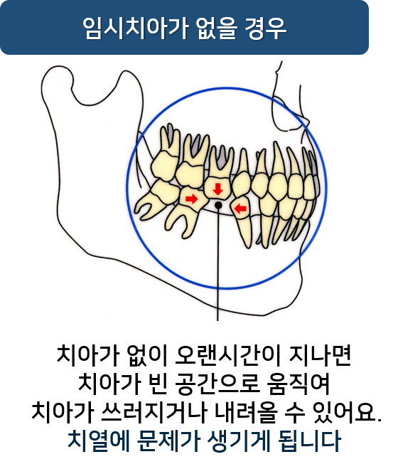 임시치아 빠짐, 빠졌을 때 어떻게? 명동 라임나무치과 관련 이미지 3