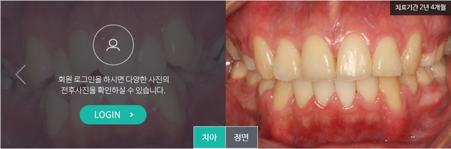 [명동 역삼 라임나무치과] 치아교정, 이런 분들께 꼭 필요해요! 관련 이미지 5