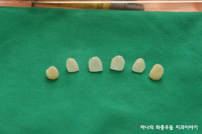 라미네이트 가격 VS 라미네이트 잘하는 명동치과 관련 이미지 4