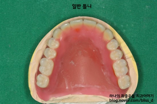 임플란트 틀니가 틀니보다 나은 이유 3가지 관련 이미지 2