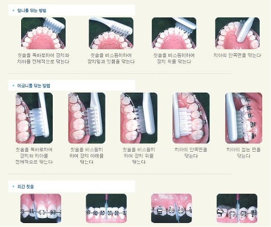 치아교정 중 양치질은 어떻게 하는 것이 좋을까 관련 이미지 4