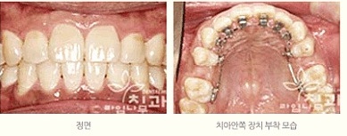 세라믹 교정 비용과 기간이 궁금하다면? 관련 이미지 3