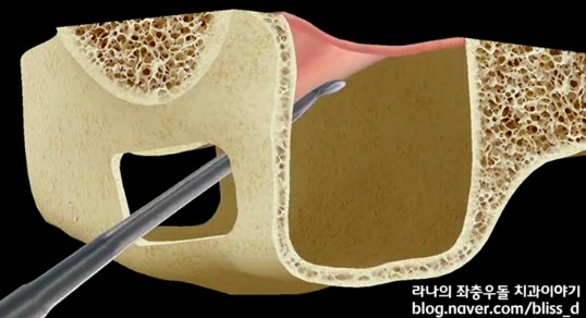 임플란트 뼈이식이 필요한 이유 관련 이미지 14