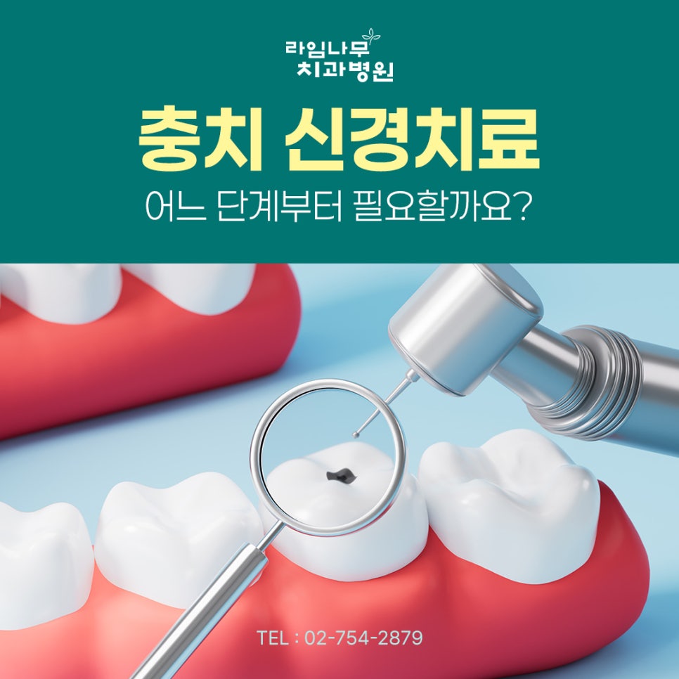 명동 치과 충치는 어느 단계부터 신경치료가 필요할까요? 관련 이미지 2