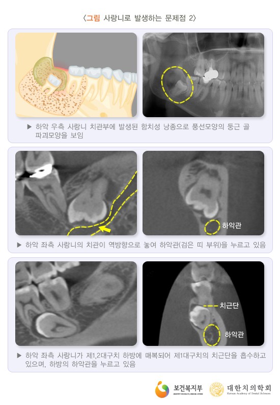 사랑니 발치에 대한 궁금증, 라나가 시원하게 해결해 드립니다 관련 이미지 6