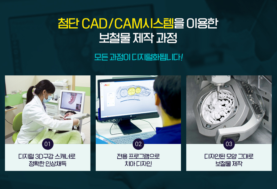 치료기간 걱정 덜어주는 당일임플란트 관련 이미지 7