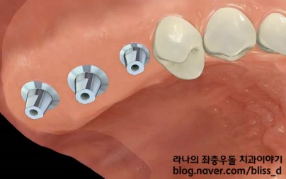 임플란트 뼈이식이 필요한 이유 관련 이미지 4