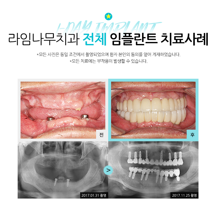 무치악임플란트 알아보고 계신다면? 라임나무치과에서 상담 받으세요! 관련 이미지 11