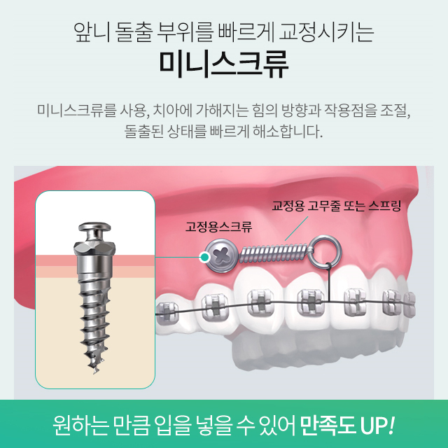 명동치과 치아교정 알아보고 계셨다면? 관련 이미지 3