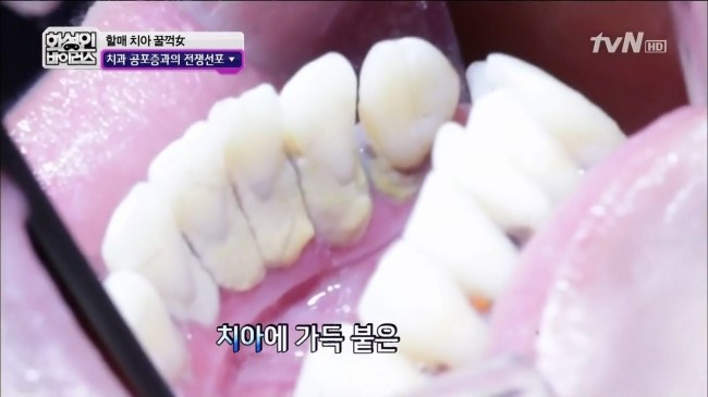 화성인 바이러스 할매치아 꿀꺽녀 in 라임나무치과 관련 이미지 6