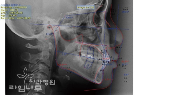 치아교정 전 진행하는 교정 진단과 검진의 차이점은? 관련 이미지 6