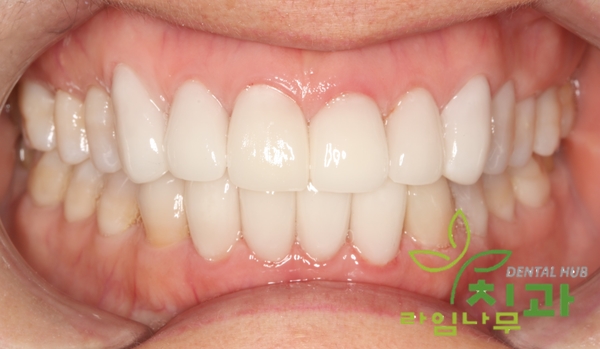 연예인 치아 성형 라미네이트, 치아 급속 교정 가능해요! 명동치과 라임나무치과 관련 이미지 6