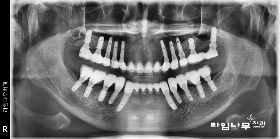 명동치과 전체임플란트 증례! 치주염으로 전체 치아의 기능을 상실한 치아 관련 이미지 7