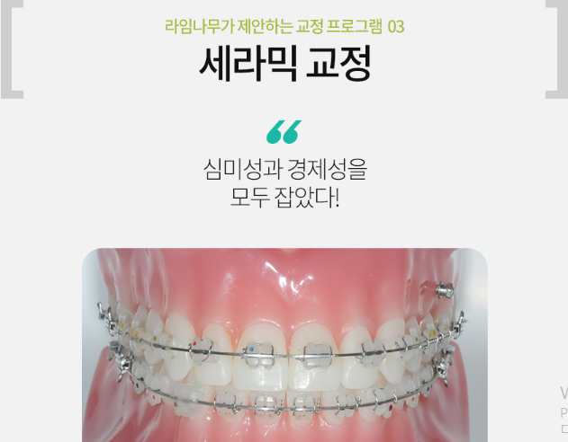 치아교정 장치 종류 (세라믹,클리피씨,에스라인교정) 관련 이미지 6