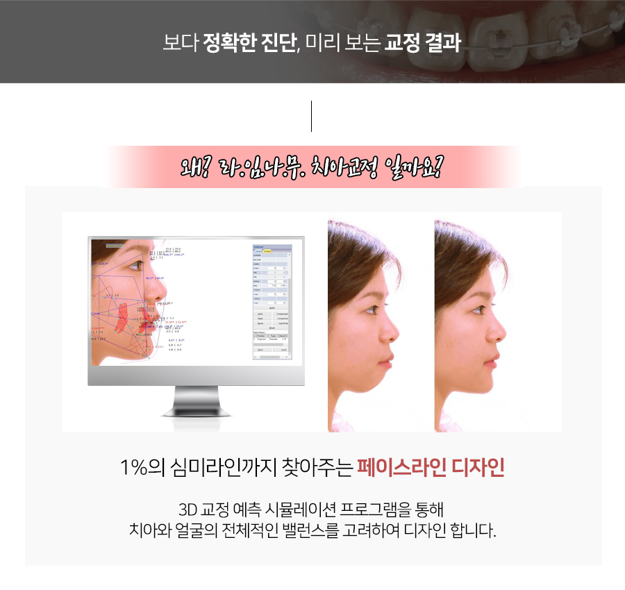 클리피씨 교정장치를 이용한 보다 빠르고 덜 아픈 교정 관련 이미지 6