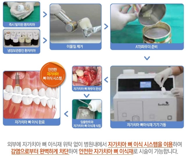 [명동치과]라임나무치과의 전체 임플란트를 소개합니다 관련 이미지 5