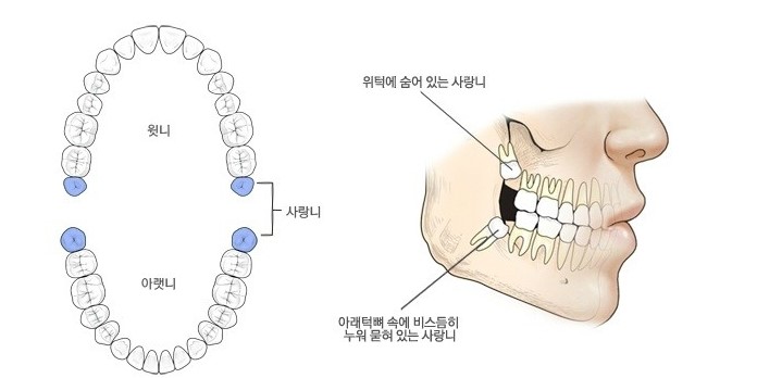 사랑니 발치에 대한 궁금증, 라나가 시원하게 해결해 드립니다 관련 이미지 2