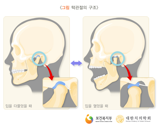 턱관절장애 원인, 어떤 것들이 있으며 치료법은 무엇인지 알아봤어요 관련 이미지 1