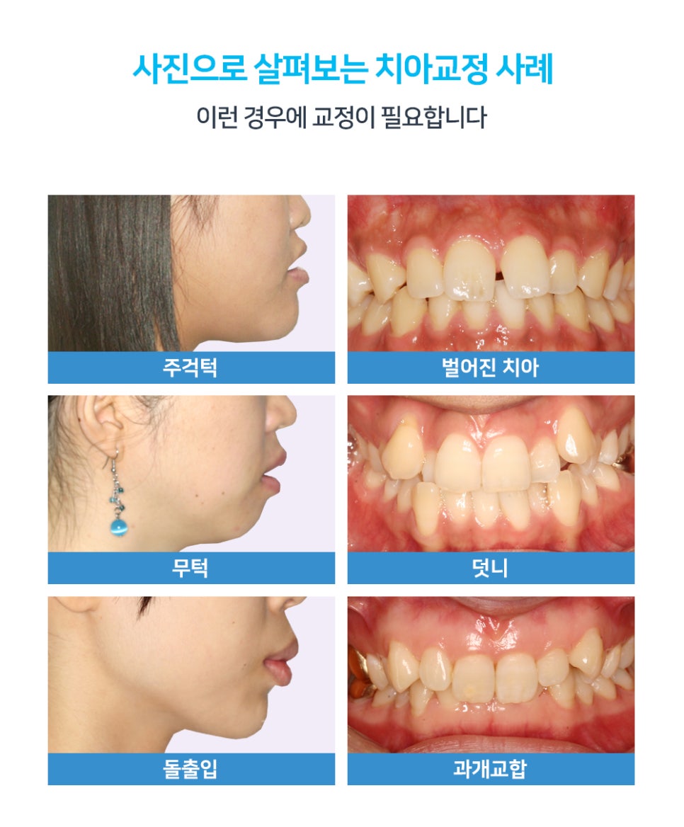 만족스런 치아교정을 위해 살펴봐야 할 것들 관련 이미지 2
