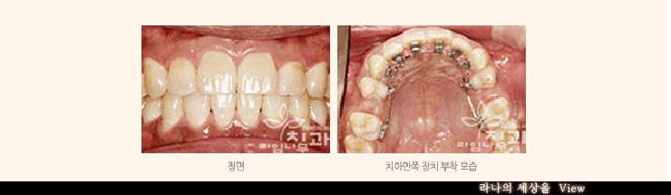 치아교정중에도 밝은 미소로 자신있게 면접보자! 관련 이미지 4