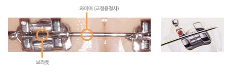 잠깐만요! 자가결찰교정장치 알고 가실께요~ 관련 이미지 3