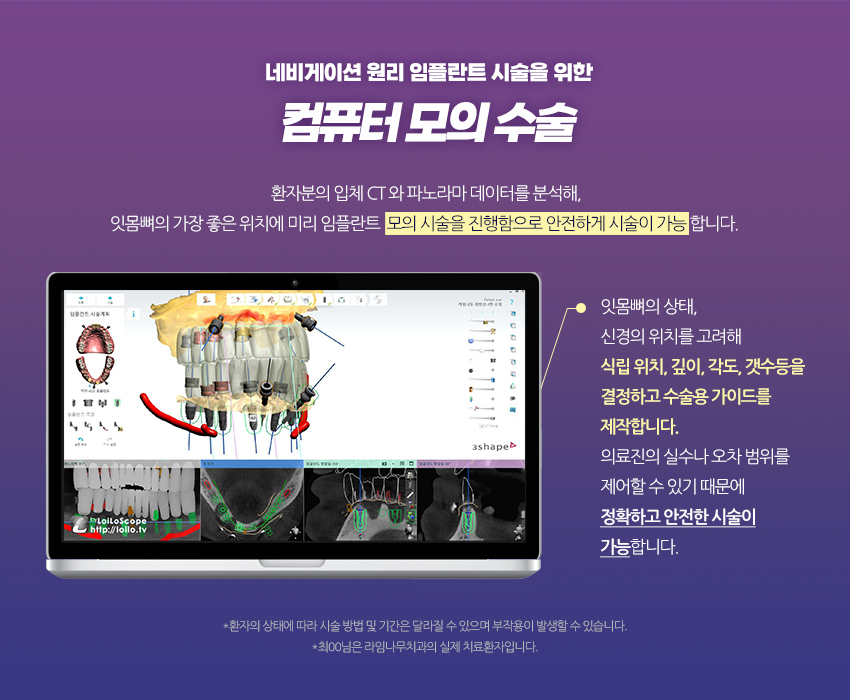 [라임나무치과]네비게이션 원리 임플란트, 실제 사례를 통해 알아봤습니다. 관련 이미지 3