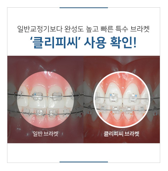 명동치과에서 비발치교정 시작해 보세요 관련 이미지 8