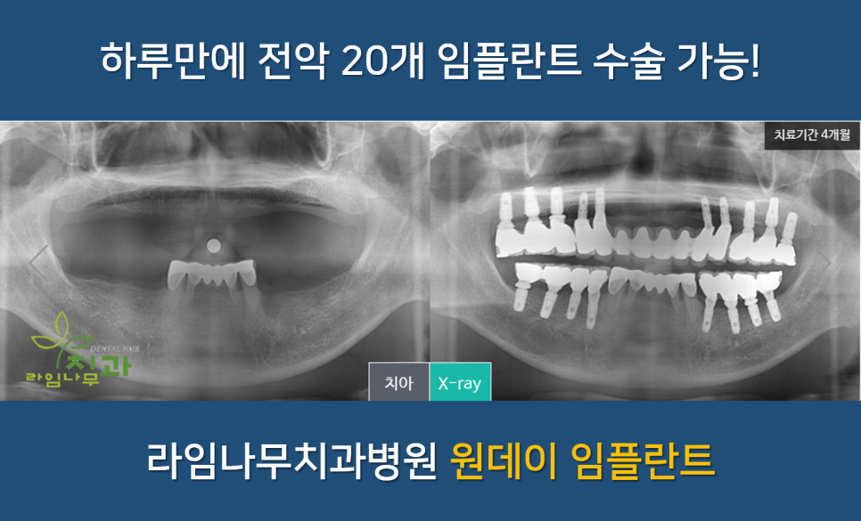 [명동치과] 하루 만에 전악 20개 임플란트 수술 가능! 라임나무치과 원데이 임플란트 관련 이미지 1