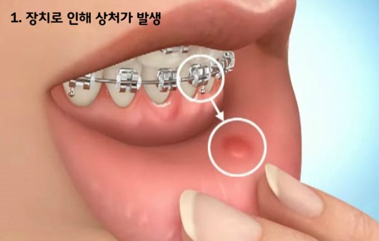 치아교정 치료 노하우 BEST3 관련 이미지 2