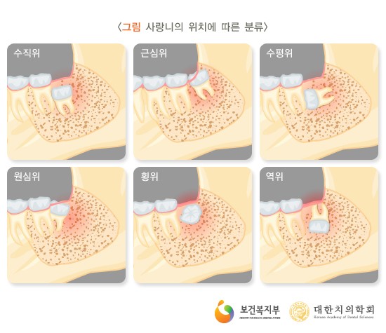 사랑니 발치에 대한 궁금증, 라나가 시원하게 해결해 드립니다 관련 이미지 4