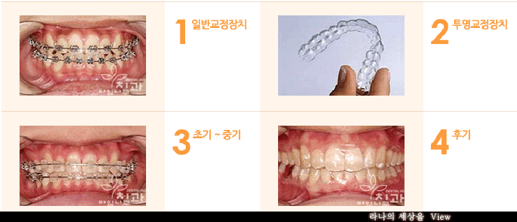 치아교정중에도 밝은 미소로 자신있게 면접보자! 관련 이미지 7