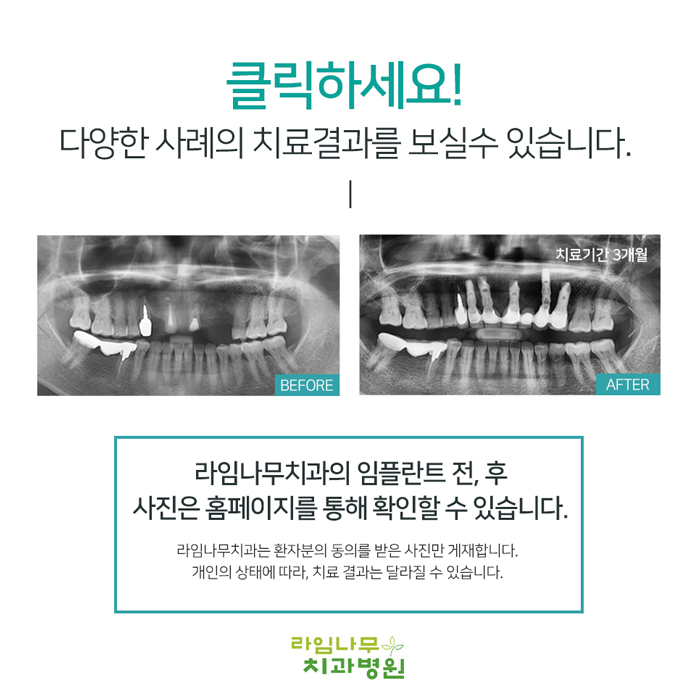 보철치료종류(레진,인레인,크라운) 유지관리방법 관련 이미지 7
