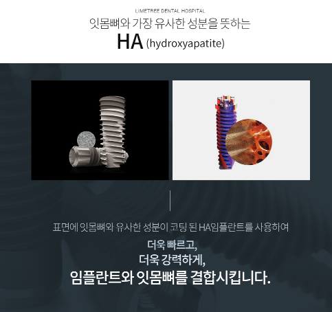 임플란트 기간 얼마나 걸릴까? 임플란트 뼈이식, 임플란트 종류 관련 이미지 10