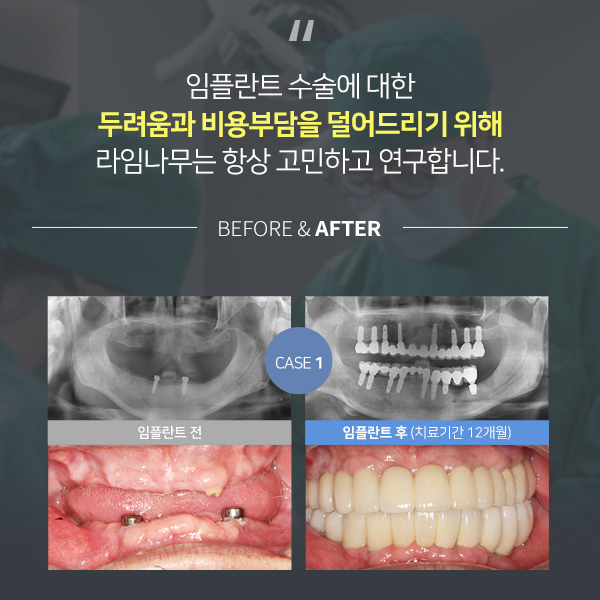 뼈이식임플란트 신중히 알아보자구요 관련 이미지 9