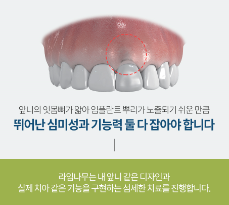 [명동치과] 앞니 임플란트 치과 고르는 방법 관련 이미지 2