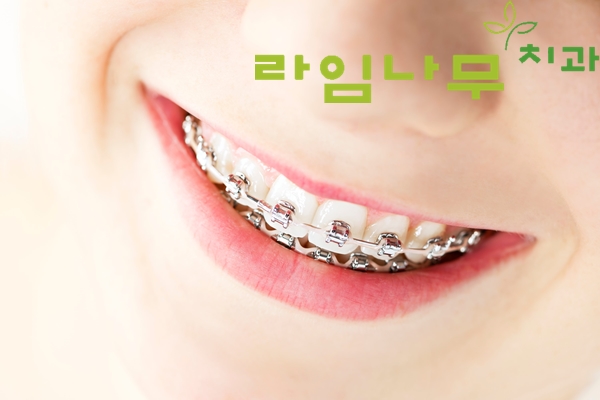 치아교정 중 어금니 파란색 레진? 제거시기 떨어졌을 때 알아봐요! 명동치과 관련 이미지 3