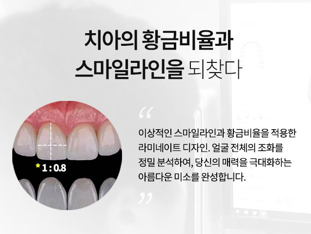 명동라미네이트 자연 치아 보존과 효율적인 시술 과정을 확인하세요 관련 이미지 5