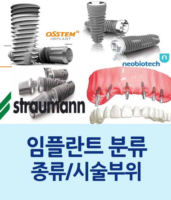 임플란트 종류와 시술부위에 따른 분류 관련 이미지 1