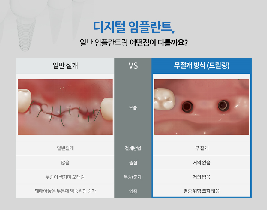 하루 만에 완성하는 임플란트, 만성질환이 있어도 OK 관련 이미지 9