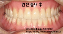 노인 틀니 건강보험 적용 되시는것 알고 계세요 ? 관련 이미지 3