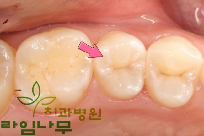 명동치과 라임나무가 알려드리는 어린이 치아상식 관련 이미지 2