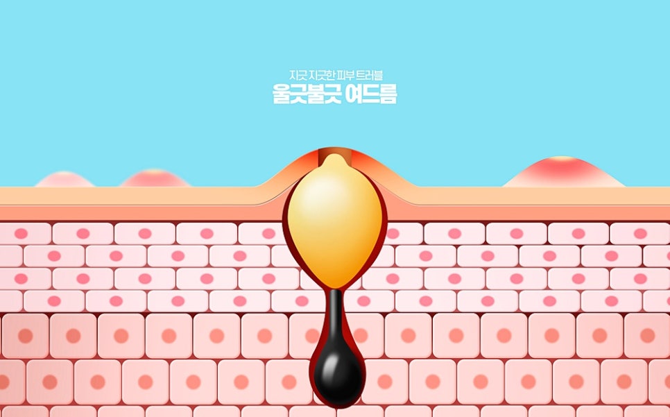 강남역 성인여드름 원장이 10대 여드름과 나눠 보는 이유 관련 이미지 7