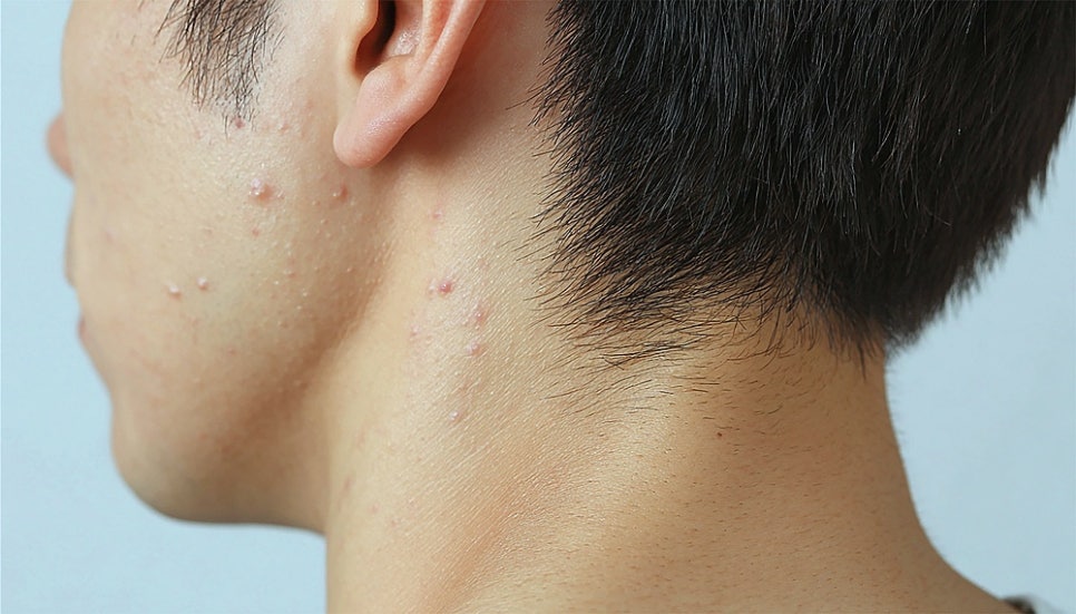 Shinnonhyeon Dermatology for Adult Acne in Men: Four Types of Male Acne and Treatment Approaches by Skin Condition image 6