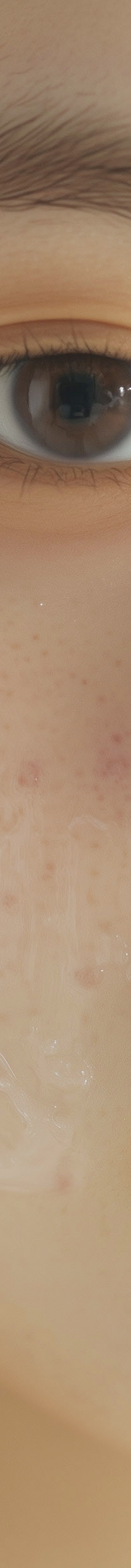 강남역여드름압출 이렇게 진행해야 해요 관련 이미지 27