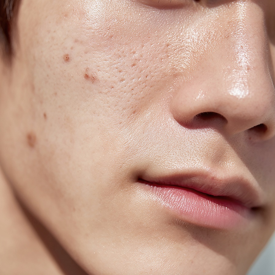 신논현 여드름치료 피부과에서 시작하세요 관련 이미지 5