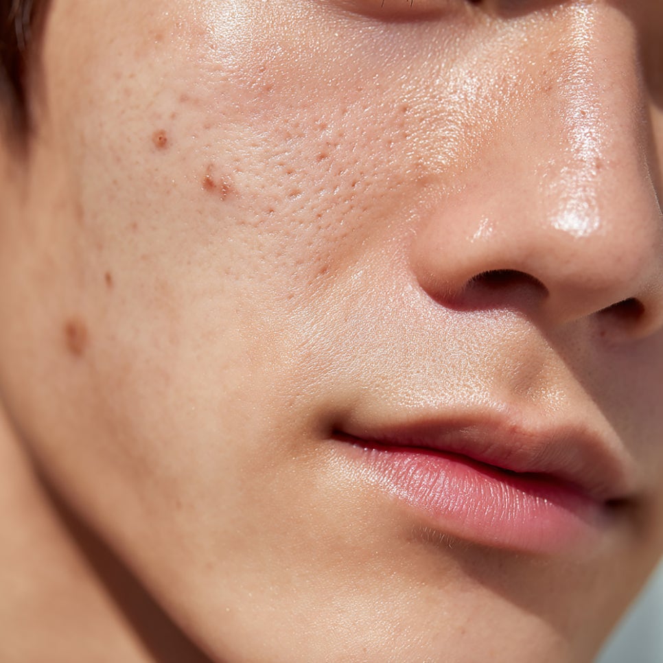 환절기 여드름 원인과 더 심해지는 이유 관련 이미지 2