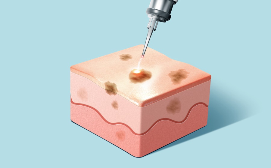 강남역기미치료 피부가 깨끗해 지는 방법 관련 이미지 7